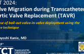 TCT 1165: Valve Migration During Transcatheter Aortic Valve Replacement (TAVR): A Case of Bail-Out Valve-in-Valve Deployment Using the Snare Technique