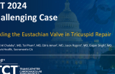 TCT 1353: Tackling the Eutachian Vlave in Tricuspid Repair 