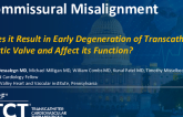 TCT 1340: Case Report: Does Commissural Misalignment Result in Early Degeneration of Transcatheter Valve and Affect Its Function?