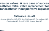 Valves on Valves: A Rare Case of Successful Transcatheter Mitral Valve Replacement Followed by Transcatheter Tricuspid Valve Replacement
