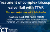 TCT 166: Treatment of Complex Tricuspid Valve Leaflet Flail With TTVR: First Successful Case With Trisol Valve