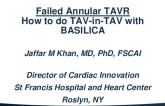 Case Presentation 2: Failed Annular TAVR and ‘How To Do’ TAV-in-TAV (e.g. With BASILICA in Sapien)