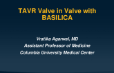 Valve-in-Valve with Basilica (Risk Assessment)