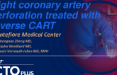 Right Coronary Artery Perforation Treated With Reverse CART