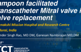 TCT 1483: LAMPOON-Assisted Transcatheter Mitral Valve-in-Valve Replacement