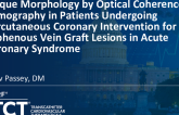 TCT 757: Plaque Morphology by Optical Coherence Tomography in Patients Undergoing Percutaneous Coronary Intervention for Saphenous Vein Graft Lesions in Acute Coronary Syndrome