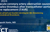 TCT 1223: An Acute Coronary Artery Obstruction Caused by Valsalva Thrombus After TAVR: A Case of Bail-Out Snorkel Stenting for Life-Threatening Periprocedural Thrombosis