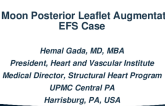 Half Moon Posterior Leaflet Augmentation: EFS Case