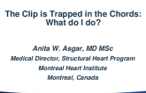 The Clip Is Entrapped in Chordae: What Do I Do?