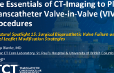 The Essentials of CT-Imaging to Plan Transcatheter Valve-in-Valve (VIV) Procedures