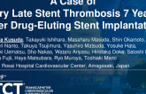 TCT 1364: A Case of Very Late Stent Thrombosis 7 Years After Drug-Eluting Stent Implantation