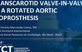 TCT 1596: Transcarotid Valve-in-Valve in a Rotated Aortic Bioprosthesis