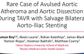 TCT 1350: A Rare Case of Avulsed Aortic Atheroma and Aortic Dissection During TAVR With Salvage Bilateral Aorto-Iliac Stenting
