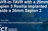 TCT 1491: TAVR-in-TAVR With a 29mm Sapien 3 Resilia Implanted Inside a 26mm Sapien 3