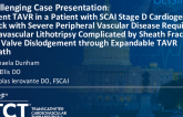 TCT 1206: Urgent TAVR in Patient With SCAI D Cardiogenic Shock With Severe Peripheral Vascular Disease Requiring Intravascular Lithotripsy Complicated by Sheath Fracture and Valve Dislodgement Through Edwards "E" Sheath
