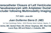 Left Ventricular Pseudoaneurysm closure using a ductal occluder planned with multimodality imaging with 3D reconstruction.  