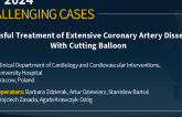 TCT 1352: Successful Treatment of Extensive Coronary Artery Dissection With Cutting Balloon