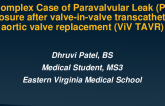 A Complex Case of Paravalvular Leak (PVL) After Valve-in-Valve Transcatheter Aortic Valve Replacement (ViV TAVR)