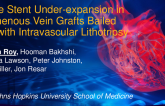 TCT 798: Acute Stent Underexpansion in Saphenous Vein Grafts Bailed Out with Intravascular Lithotripsy