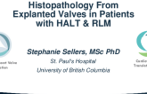 Histopathology From Explanted Valves in Patients With HALT and RLM