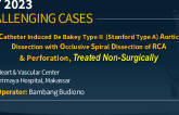 TCT 938: Catheter Induced De Bakey Type II (Stanford Type A) Aortic Dissectionwith Occlusive Spiral Dissection of RCA & Perforation, Treated Non-Surgically