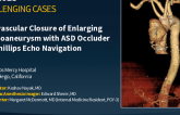 TCT 997: Percutaneous closure of ascending aortic pseudoaneurysm using adjunct imaging with Phillips Echonavigator guidance