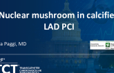 TCT 1150: Nuclear Mushroom in Calcified LAD PCI