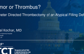TCT 1326: Tumor or Thrombus? Catheter Directed Thrombectomy of an Atypical Filling Defect