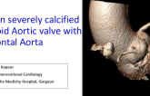 TAVR in Extremely Horizontal Anatomy