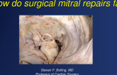 How Do Surgical Mitral Valve Repairs Fail?