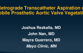 TCT 886: Successful Retrograde Transcatheter Mechanical Thrombectomy and Aspiration of Mobile Prosthetic Aortic Valve Vegetation from Endocarditis