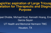 TCT 887: Angiovac aspiration of Large Tricuspid Vegetation for Theraeupeutic and Diagnostic Purpose 