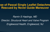 Case of Pascal Single Leaflet Detachment Rescued by Novel Guide Maneuver