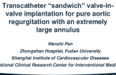 TCT 915:  Transcatheter “sandwich” valve-in-valve implantation for pure aortic regurgitation with an extremely large annulus