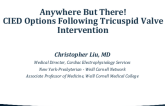Anywhere But There: CIED Options (PPM/ICD) in Patients Following Tricuspid Valve Intervention