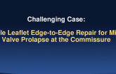 TCT 1261: Single Leaflet Edge-to-Edge Repair for Mitral Valve Prolapse at the Commissure