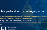 TCT 1448: Double Perforations, Double Jeopardy: LM And Distal LAD Perforation Caused by Removal of Rotational Atherectomy Burr Entrapment in the Patient With Severe Aortic Stenosis