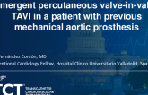 TCT 1355: Emergent Percutaneous Valve-in-Valve Procedure in a Patient With Previous Mechanical Ascending Aortic Prothesis