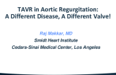 SPOTLIGHT INNOVATION LECTURE: TAVR in Aortic Regurgitation: A Different Disease, A Different Valve!