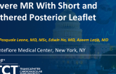 Case Presentation 3: Severe MR With Short and Tethered Posterior Leaflet