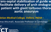 TCT 1175: Trans-septal Stabilization of Guide Wire to Facilitate Delivery of Arch Endograft in a Patient With Giant Tortuous Thoracic Aortic Aneurysm