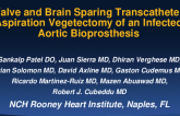 Valve and Brain Sparing Transcatheter Aspiration Vegetectomy in an Infected Aortic Valve Bioprosthesis