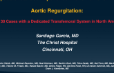 Compassionate Use Experience with J-Valve for Native Aortic Regurgitation: First 30 Cases with a Dedicated Transfemoral System in North America