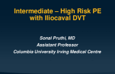 Case 3: High Risk Intermediate PE With Iliocaval DVT