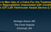 First in Man J-Valve Transcatheter Treatment of Native Valve Aortic Regurgitation Associated with a Left Ventricular Assist Device