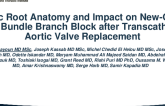 Aortic Root Anatomy and Impact on New-Onset Left Bundle Branch Block After Transcatheter Aortic Valve Replacement