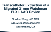Transcatheter Extraction of a Migrated 31mm Watchman FLX LAAO Device