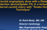 TCT 999: Carotid angioplasty done with a Distal protection device(Spider FX) in a tortuous internal carotid artery with “Snake Hunt Technique”  