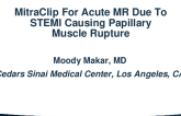 MitraClip For Acute MR Due To STEMI Causing Papillary Muscle Rupture
