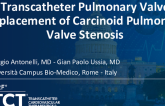 TCT 1189: Transcatheter Pulmonary Valve Replacement of Carcinoid Pulmonary Valve Stenosis